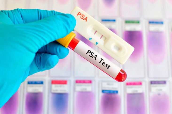 La prueba del PSA reduce el riesgo de fallecer por cáncer de próstata